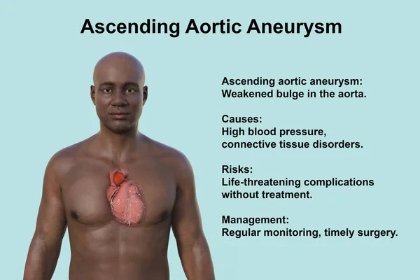 A 3D photorealistic illustration of the upper half part of an African man with transparent skin, revealing an ascending aortic aneurysm