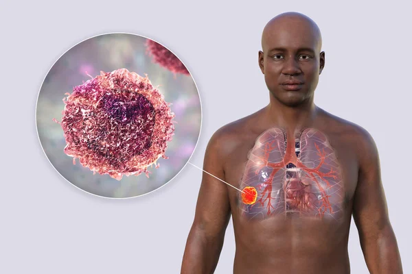 一张关于一个皮肤透明的非洲男人上半身的3D照片 揭示了肺癌的存在 以及癌细胞的特写 — 图库照片