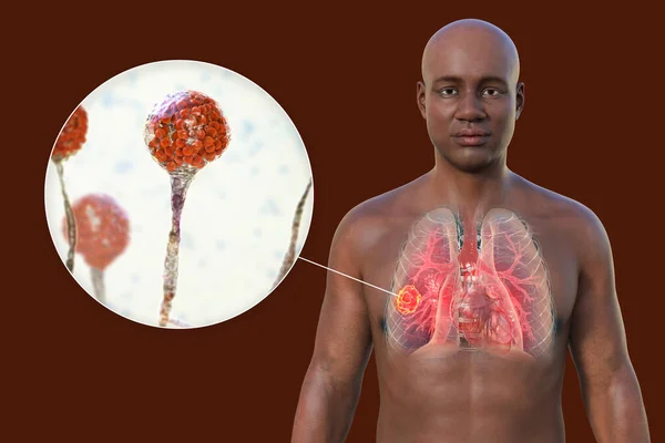 图为一个皮肤透明的非洲男子上半身的3D照片 显示了肺粘液菌病的病变 并近距离观察了Mucor真菌 — 图库照片