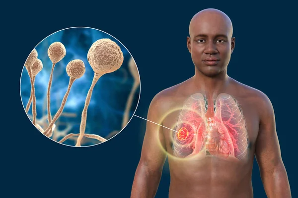 图为一个皮肤透明的非洲男子上半身的3D照片 显示了肺粘液菌病的病变 并近距离观察了Mucor真菌 — 图库照片