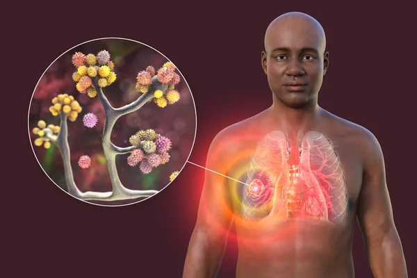 图为一个皮肤透明的非洲男子上半身的3D照片 显示了肺部粘液真菌病的病灶 并近距离观察了金银花真菌 — 图库照片