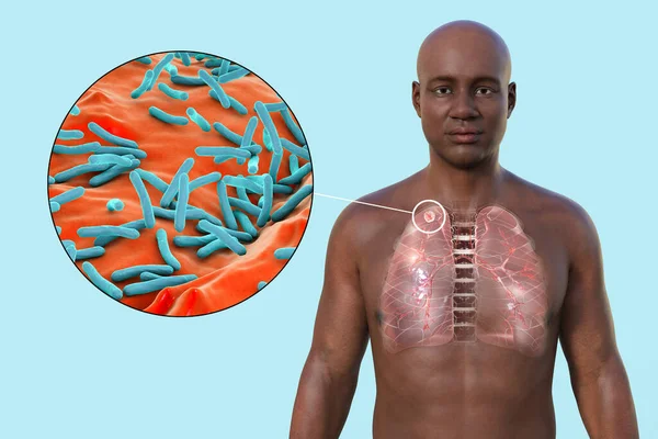 A 3D illustration showcasing the upper half part of an African man with transparent skin, revealing the lungs affected by secondary tuberculosis and closeup view of Mycobacterium tuberculosis bacteria