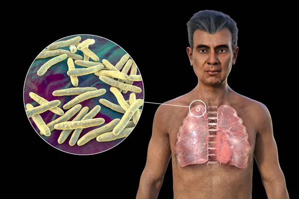 A 3D illustration showcasing the upper half part of an Indian man with transparent skin, revealing the lungs affected by secondary tuberculosis and close-up view of Mycobacterium tuberculosis bacteria