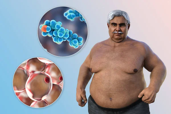 Medical Illustration Featuring Senior Overweight Man Close View Adipocytes Cholesterol — Stock Photo, Image