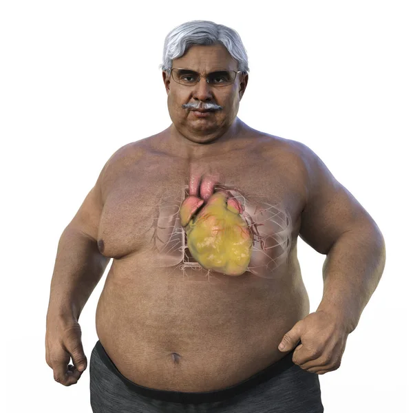 Medyczna Ilustracja Starszego Mężczyzny Nadwagą Przezroczystą Skórą Powiększonym Otyłym Sercem — Zdjęcie stockowe