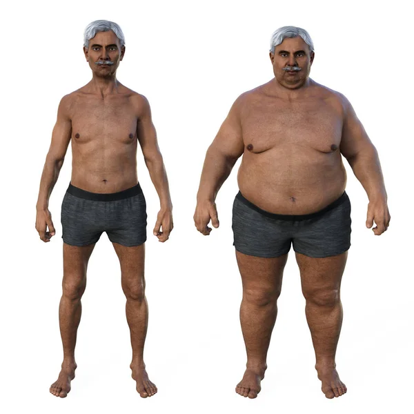 Comparative Medical Illustration Depicting Normal Weight Senior Indian Man Same — Stock Photo, Image