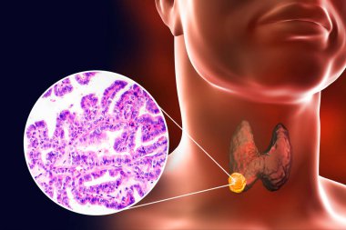A 3D scientific illustration showcasing a human body with transparent skin, revealing a tumor in his thyroid gland, along with a micrograph image of papillary thyroid carcinoma. clipart