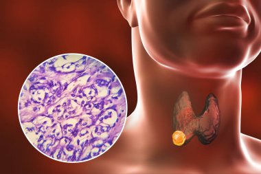 Üç boyutlu bilimsel bir illüstrasyon, tiroid bezindeki tümörü ve tiroid foliküler karsinomu gösteren şeffaf derili bir insan vücudunu gösteriyor..