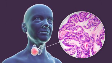 Üç boyutlu bilimsel bir illüstrasyon, tiroid bezindeki tümörü ve papiller tiroid kanserinin mikro resmini gösteren şeffaf ciltli bir kadın vücudunu gösteriyor..