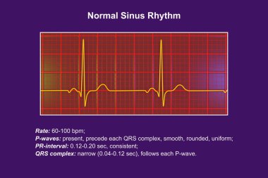 Normal bir elektrokardiyogram EKG, sağlıklı bir bireyde kalbin elektriksel aktivitesini gösteren 3 boyutlu bir çizim..