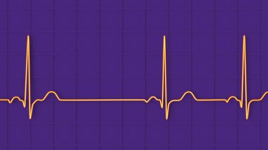 Sinüs aritmisini gösteren elektrokardiyogramın ayrıntılı bir 3D çizimi sinüs düğümünden kaynaklanan düzensiz kalp ritmiyle karakterize edilen bir durumdur..
