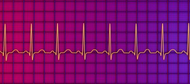 Elektrokardiyogramın detaylı bir 3D çizimi sinüs taşikardisi gösteriyor. Kalp ritmi normal kalp ritmi 90-100 bpm 'in üst sınırından daha yüksek..