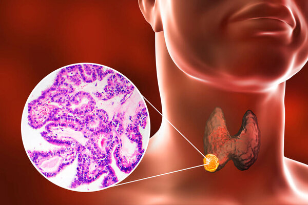 3D научная иллюстрация, демонстрирующая человеческое тело с прозрачной кожей, показывающая опухоль в щитовидной железе, а также микрографическое изображение папиллярной опухоли щитовидной железы.