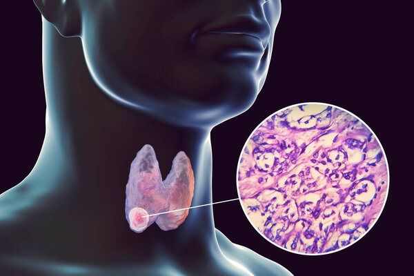 3D научная иллюстрация, демонстрирующая человеческое тело с прозрачной кожей, показывающая опухоль в щитовидной железе, а также микрографическое изображение фолликулярной опухоли щитовидной железы.