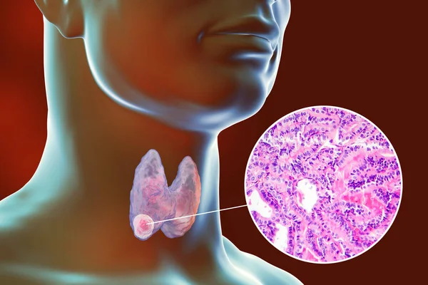 甲状腺に腫瘍があること 乳頭甲状腺がんの顕微鏡像とともに 透明な皮膚を持つ人体を示す3D科学図 — ストック写真