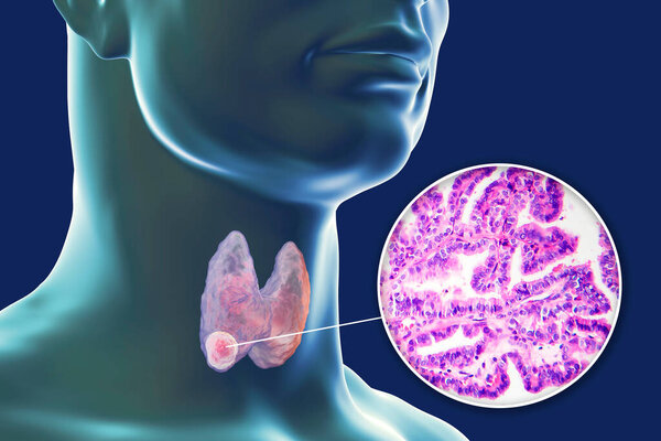 3D научная иллюстрация, демонстрирующая человеческое тело с прозрачной кожей, показывающая опухоль в щитовидной железе, а также микрографическое изображение папиллярной опухоли щитовидной железы.