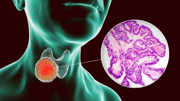 Научная Иллюстрация Демонстрирующая Человеческое Тело Прозрачной Кожей Показывающая Опухоль Щитовидной — стоковое фото
