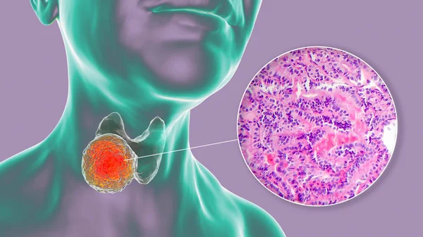 Scientific Illustration Showcasing Human Body Transparent Skin Revealing Tumor His — Stock Photo, Image