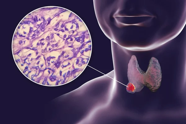 甲状腺に腫瘍があること 甲状腺濾胞がんの顕微鏡像とともに 透明な皮膚を持つ人間の体を示す3D科学図 — ストック写真