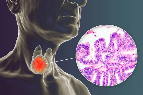 甲状腺に腫瘍があること 乳頭甲状腺がんの顕微鏡像とともに 透明な皮膚を持つ人体を示す3D科学図 — ストック写真
