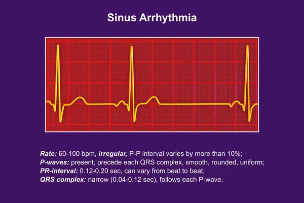 Detailní Ilustrace Elektrokardiogramu Ekg Zobrazujícího Sinusovou Arytmii Stav Charakterizovaný Nepravidelnými — Stock fotografie