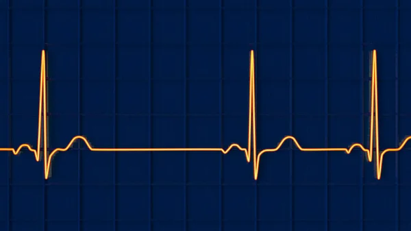 Λεπτομερής Τρισδιάστατη Απεικόνιση Ηλεκτροκαρδιογραφήματος Ηκγ Φλεβοκομβική Αρρυθμία Πάθηση Που Χαρακτηρίζεται — Φωτογραφία Αρχείου