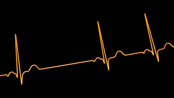 心电图显示窦性心律失常的详细三维图像 窦性心律失常是以窦性心律失常为特征的心律失常 — 图库照片