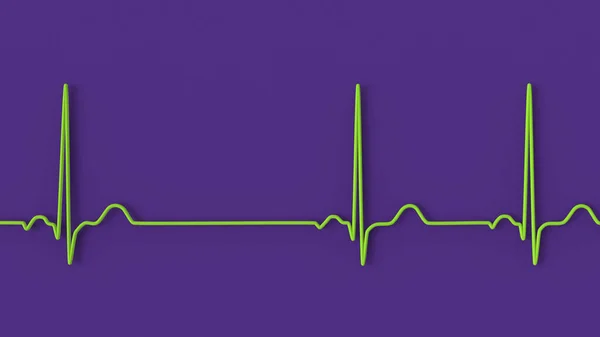 Eine Detaillierte Illustration Eines Elektrokardiogramm Ekgs Zur Darstellung Von Sinusrhythmusstörungen — Stockfoto