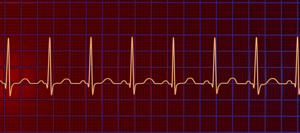 Részletes Illusztráció Elektrokardiogram Ekg Megjelenítő Sinus Tachycardia Rendszeres Szívritmus Pulzusszám — Stock Fotó
