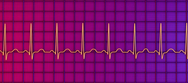 Részletes Illusztráció Elektrokardiogram Ekg Megjelenítő Sinus Tachycardia Rendszeres Szívritmus Pulzusszám — Stock Fotó