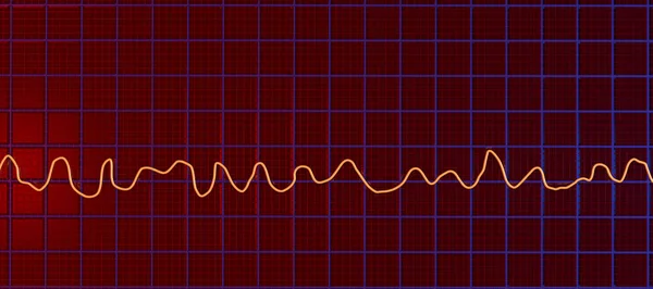 一个描述心电图心电图 Ecg 的三维科学图解 显示了心房颤动的混沌节律 一种危及生命的心律失常 — 图库照片