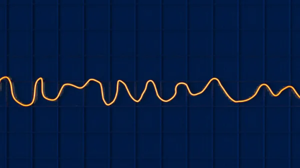 Scientific Illustration Depicting Electrocardiogram Ecg Displaying Chaotic Rhythm Ventricular Fibrillation — Stock Photo, Image