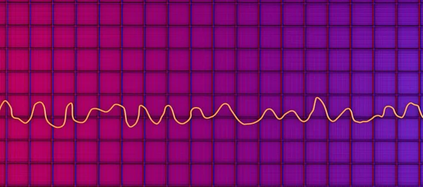 Vědecká Ilustrace Zobrazující Elektrokardiogram Ekg Zobrazující Chaotický Rytmus Fibrilace Komor — Stock fotografie