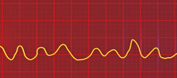 Naukowa Ilustracja Przedstawiająca Elektrokardiogram Ekg Ukazujący Chaotyczny Rytm Migotania Komór — Zdjęcie stockowe