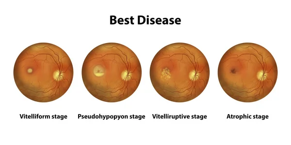 Stages Best Disease Ophthalmoscope View Scientific Illustration — Stock Photo, Image