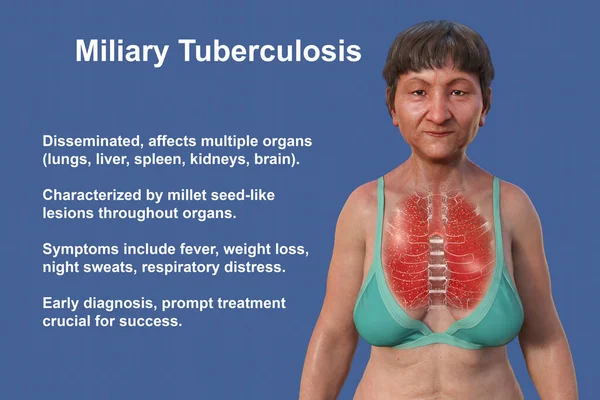Şeffaf Derili Bir Kadının Askeri Tüberkülozdan Etkilenen Akciğerlerini Gösteren Boyutlu — Stok fotoğraf