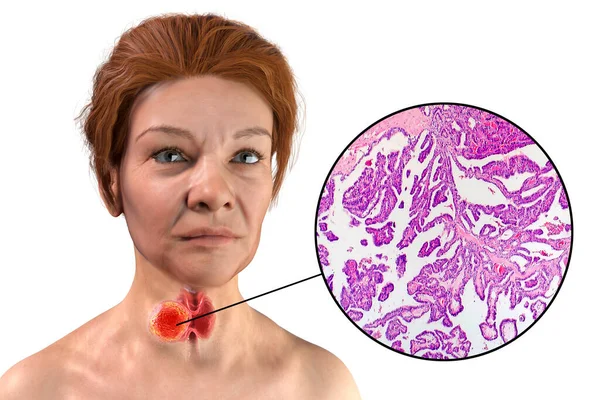 Scientific Illustration Showcasing Woman Transparent Skin Revealing Tumor Her Thyroid — Stock Photo, Image