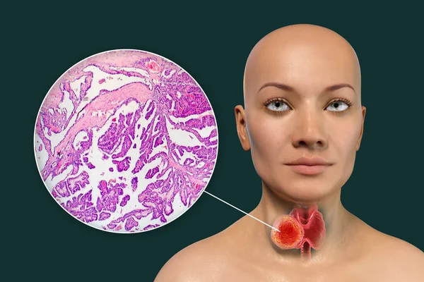 这是一个三维科学图解 展示了一个皮肤透明的女人 揭示了她甲状腺中的一个肿瘤 以及一个乳头状甲状腺癌的显微图像 — 图库照片