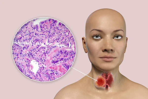 Vetenskaplig Illustration Visar Kvinna Med Transparent Hud Avslöjar Tumör Sköldkörteln — Stockfoto