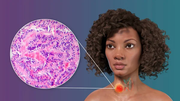 Vetenskaplig Illustration Visar Kvinna Med Transparent Hud Avslöjar Tumör Sköldkörteln — Stockfoto