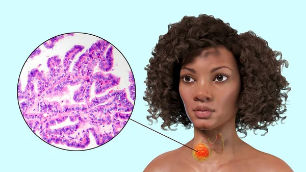 这是一个三维科学图解 展示了一个皮肤透明的女人 揭示了她甲状腺中的一个肿瘤 以及一个乳头状甲状腺癌的显微图像 — 图库照片