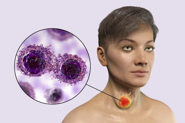 Illustration Kvinna Med Sköldkörtelcancer Med Transparent Hud Som Avslöjar Tumör — Stockfoto