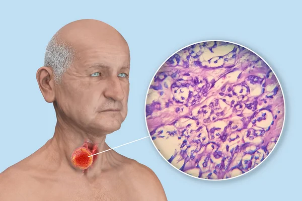 Vetenskaplig Illustration Visar Man Med Transparent Hud Avslöjar Tumör Sköldkörteln — Stockfoto