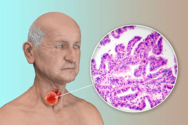 Videnskabelig Illustration Fremvisning Mand Med Gennemsigtig Hud Afslører Tumor Hans - Stock-foto