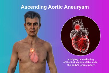 Şeffaf derisi olan yaşlı bir adamın üst kısmının 3 boyutlu fotorealistik bir çizimi, yükselen bir aort anevrizmasını ortaya çıkarıyor..