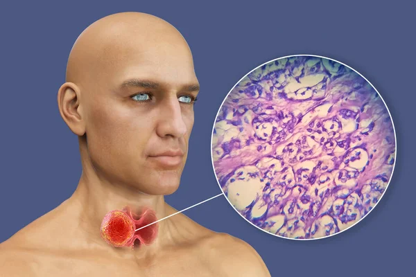 Scientific Illustration Showcasing Man Transparent Skin Revealing Tumor His Thyroid — Stock Photo, Image