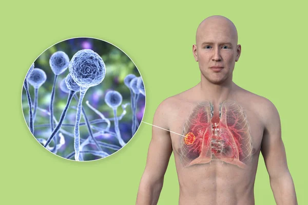 一个有透明皮肤的男子上半身的3D照片 揭示了肺黏液菌病的病变 并近距离观察了Mucor真菌 — 图库照片