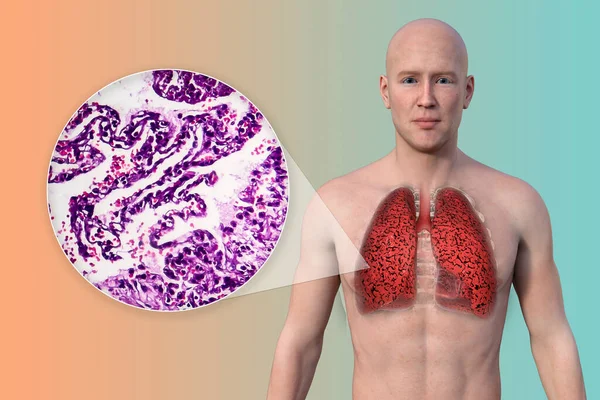 图为一个皮肤透明的男人上半身的3D图像 揭示了吸烟者的肺状况 同时还附有一张受吸烟影响的肺的显微图像 — 图库照片