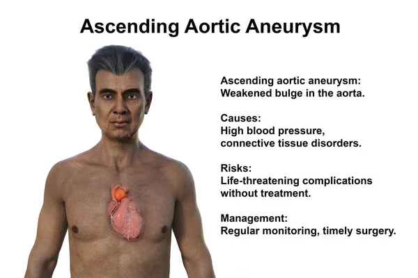 A 3D photorealistic illustration of the upper half part of a senior man with transparent skin, revealing an ascending aortic aneurysm.
