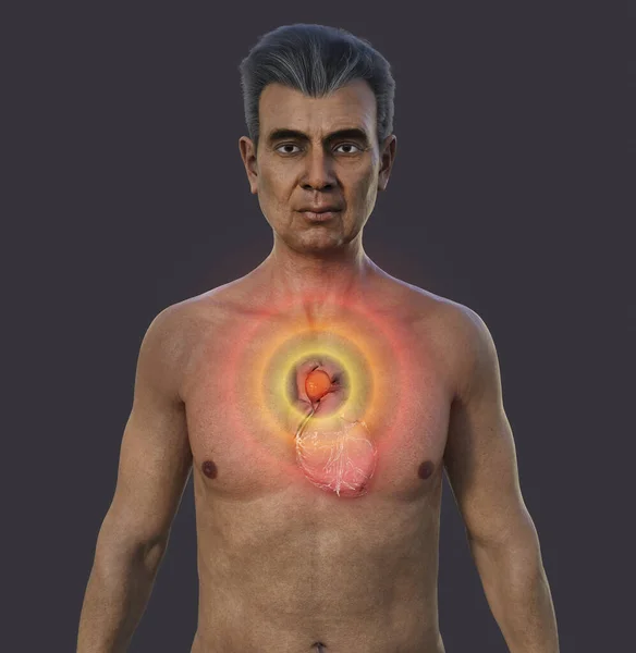 A 3D photorealistic illustration of the upper half part of a senior man with transparent skin, revealing an ascending aortic aneurysm.